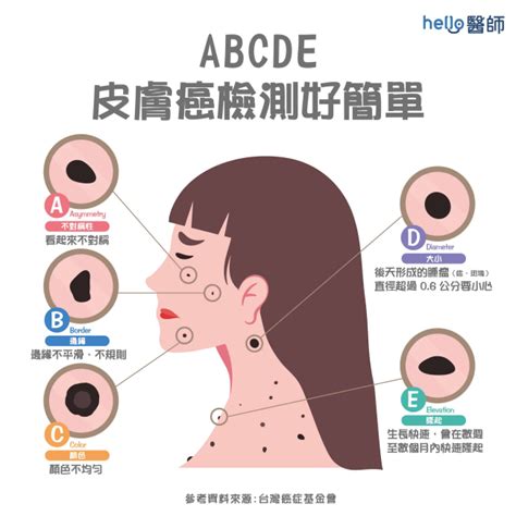 身體的痣|皮膚長痣、長斑是皮膚癌前兆？皮膚癌初期4大症狀快。